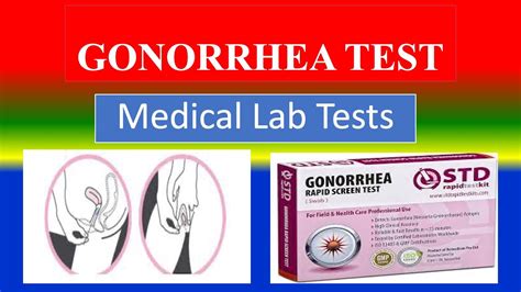 equivocal gonorrhea result|Gonorrhea Test: MedlinePlus Medical Test.